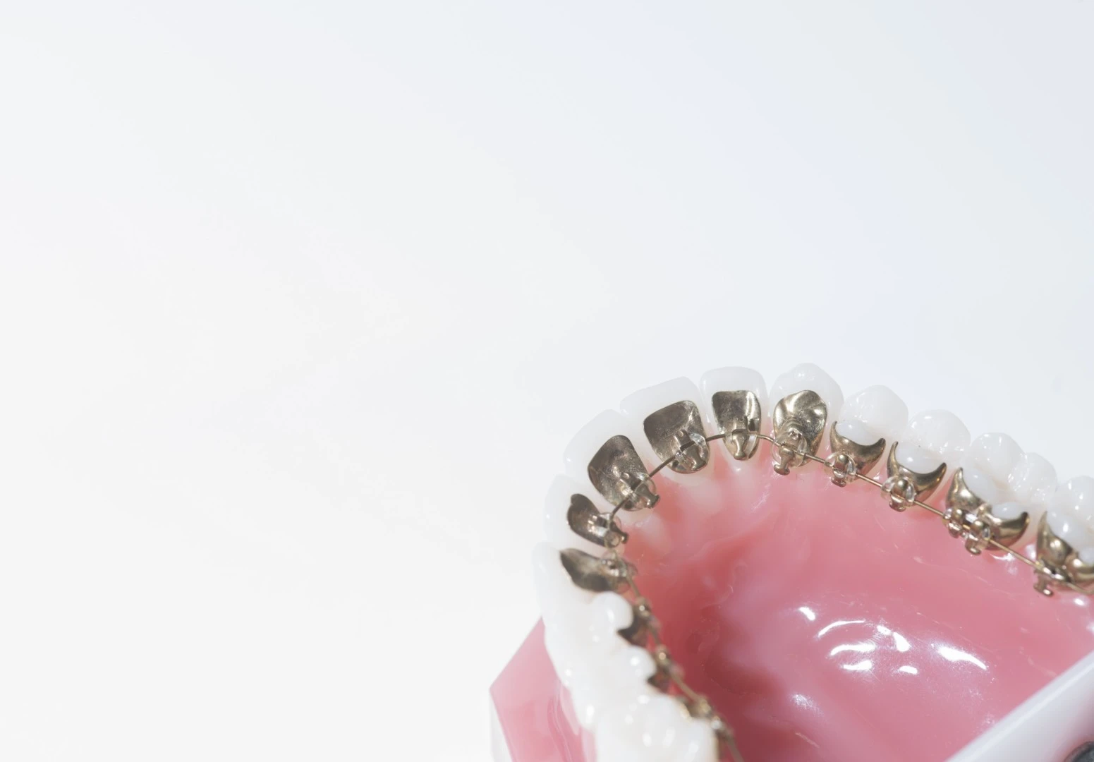 La gouttière dentaire au cœur de l'orthodontie fonctionnelle